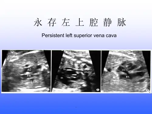 永存左上腔静脉