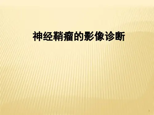 神经鞘瘤的影像诊断精品课件