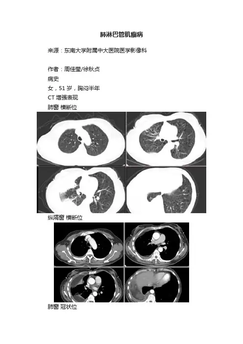 肺淋巴管肌瘤病