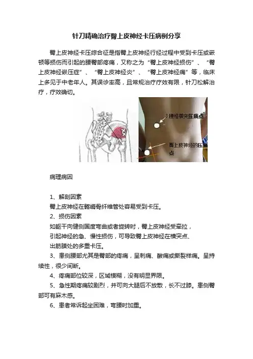 针刀精确治疗臀上皮神经卡压病例分享