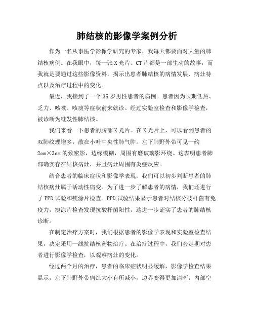 肺结核的影像学案例分析