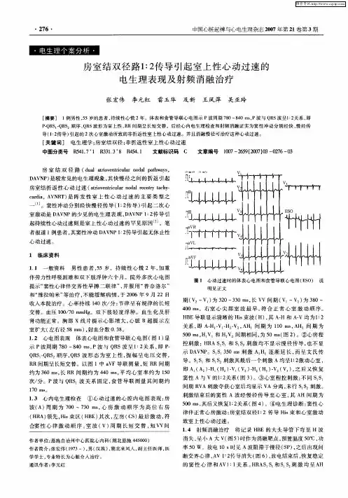 房室结双径路1：2传导引起室上性心动过速的电生理表现及射频消融治疗