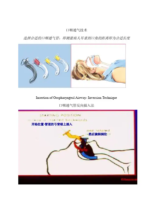口咽通气技术