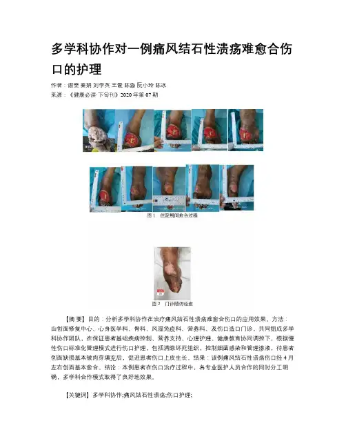 多学科协作对一例痛风结石性溃疡难愈合伤口的护理