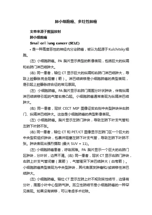 肺小细胞癌、多灶性肺癌