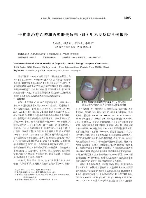 干扰素治疗乙型和丙型肝炎致指(趾)甲不良反应4例报告 王晶波