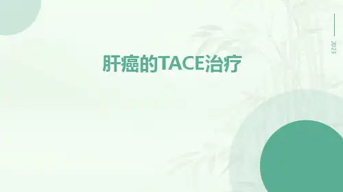 肝癌的TACE治疗治疗