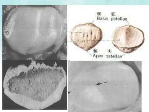 髌股关节解剖和影像参数测量.ppt