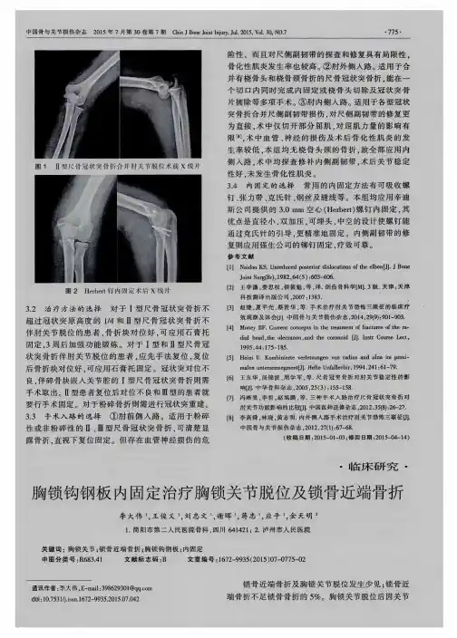 胸锁钩钢板内固定治疗胸锁关节脱位及锁骨近端骨折