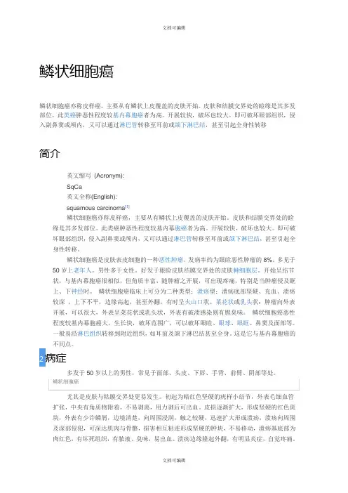 鳞状细胞癌