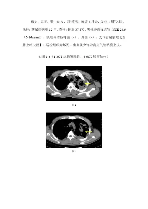 双肺多发大小不等结节病变--继发型肺结核