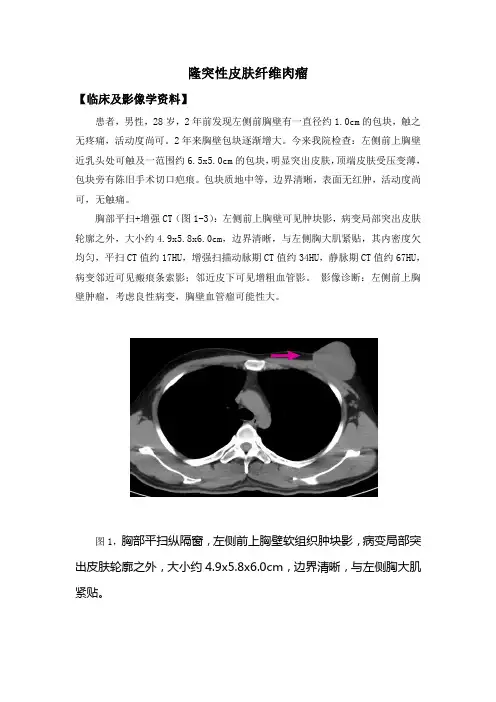 隆突性皮肤纤维肉瘤CT