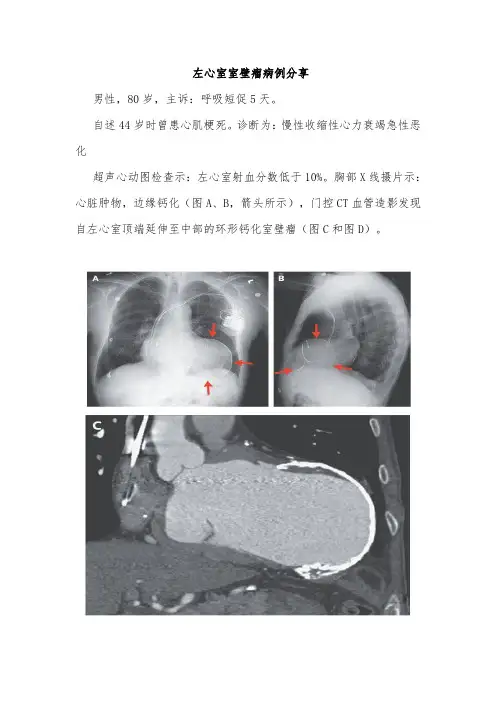左心室室壁瘤病例分享