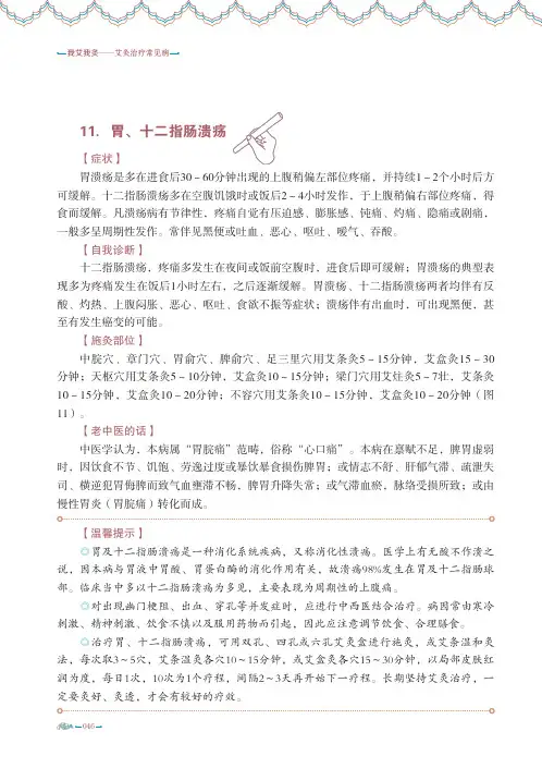 艾灸治疗常见病胃十二指肠溃疡胃下垂胃肠痉挛症慢性肠炎结肠炎腹泻细菌性痢疾慢性阑尾炎便秘便血疟疾