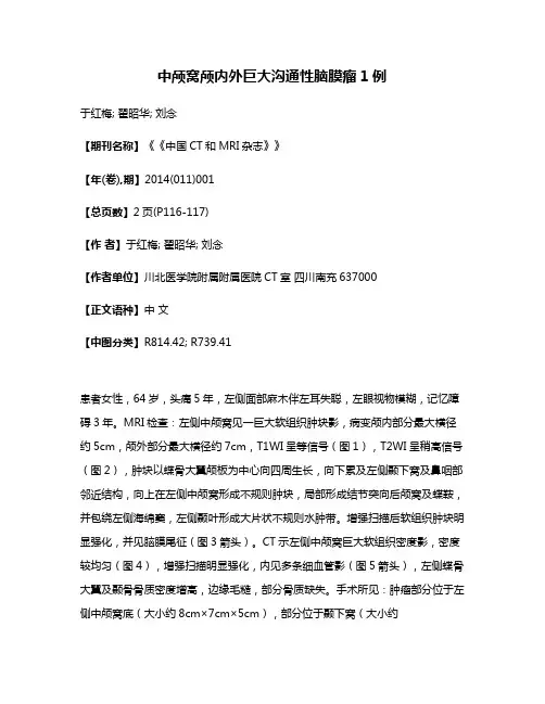 中颅窝颅内外巨大沟通性脑膜瘤1例