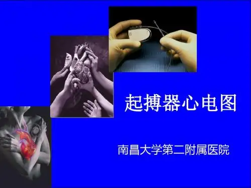 常见起搏器心电图解读ppt课件
