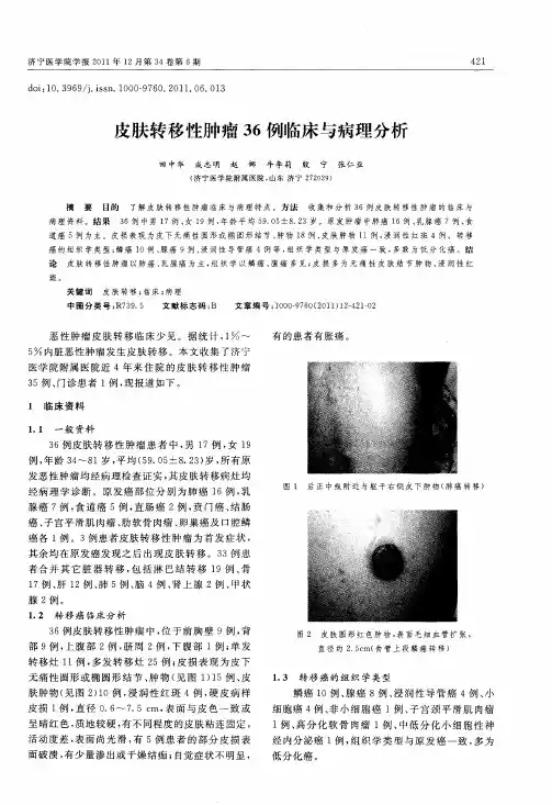 皮肤转移性肿瘤36例临床与病理分析