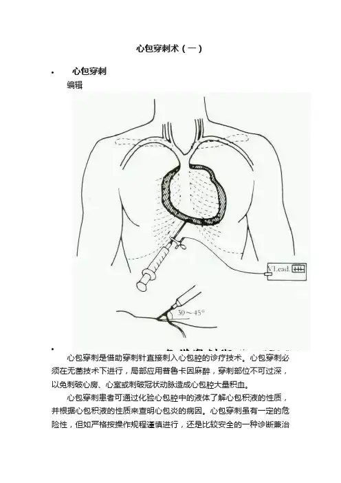 心包穿刺术（一）