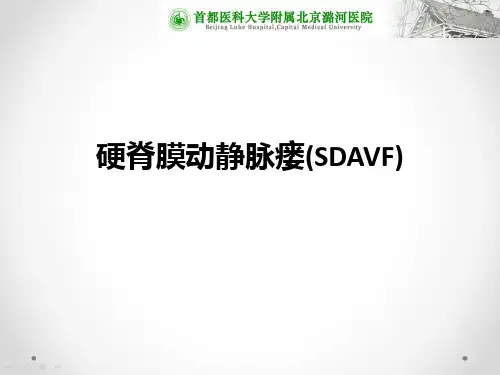 硬脊膜动静脉瘘(SDAVF)ppt课件