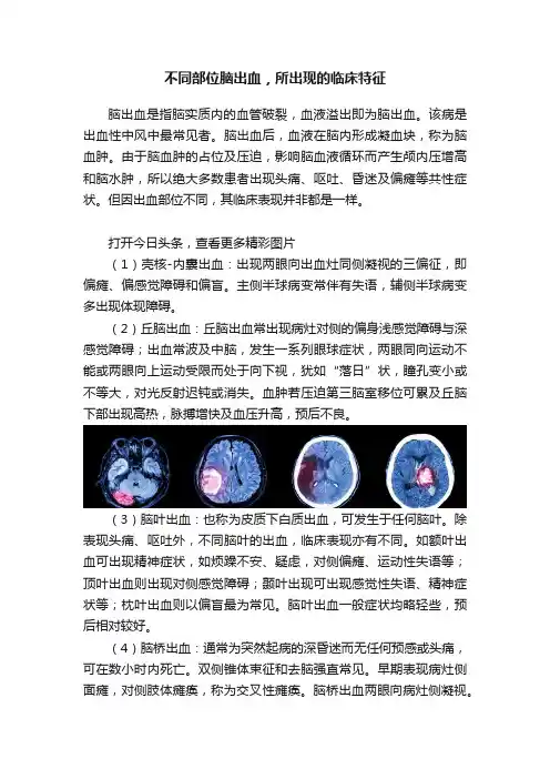 不同部位脑出血，所出现的临床特征