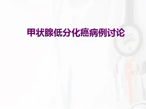 甲状腺低分化癌病例讨论一篇