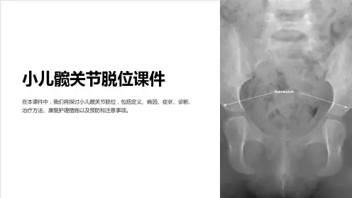 小儿髋关节脱位课件