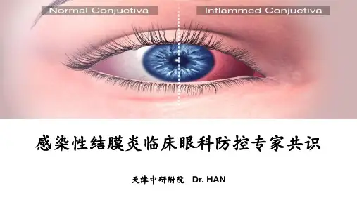 感染性结膜炎临床眼科防控专家共识