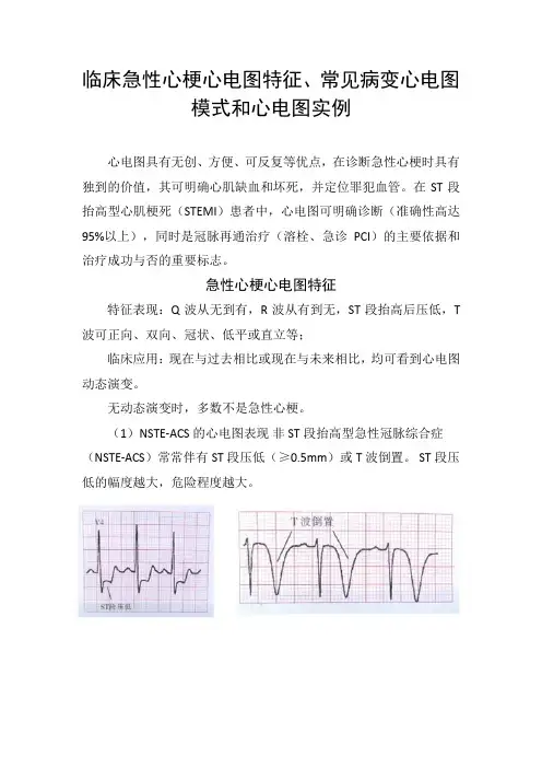 临床急性心梗心电图特征、常见病变心电图模式和心电图实例