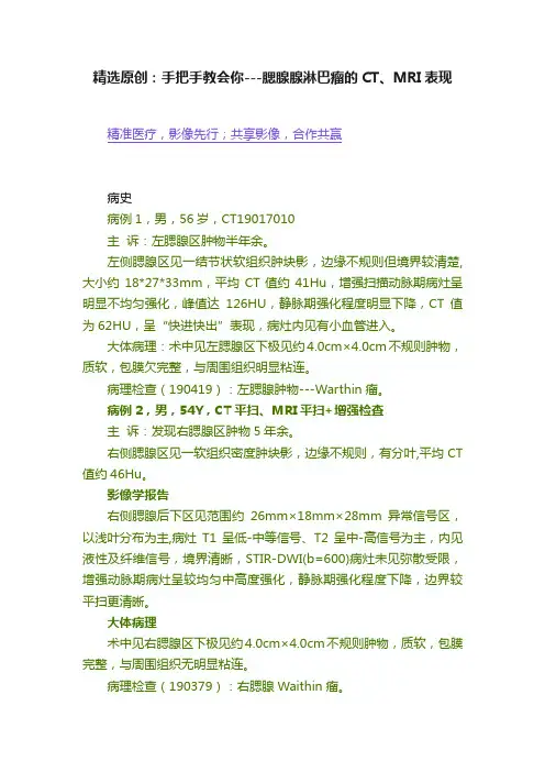 精选原创：手把手教会你---腮腺腺淋巴瘤的CT、MRI表现