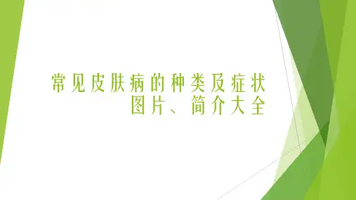 常见皮肤病的种类及症状图片、简介大全ppt课件