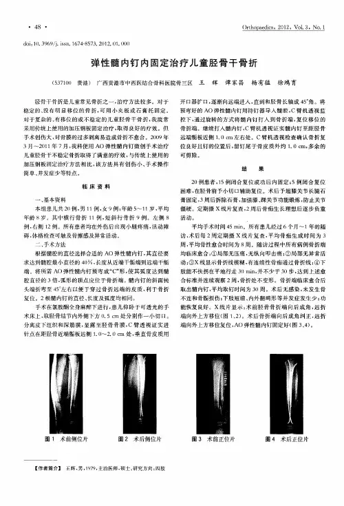 弹性髓内钉内固定治疗儿童胫骨干骨折