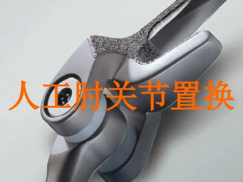 人工肘关节置换