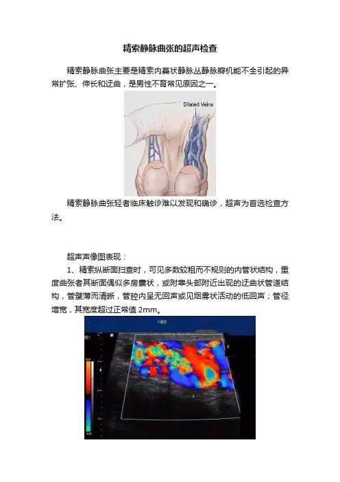 精索静脉曲张的超声检查
