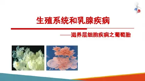滋养层细胞疾病—葡萄胎(病理学课件)