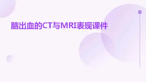 脑出血的ct与mri表现课件