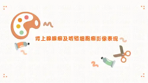 肾上腺腺瘤与嗜铬细胞瘤的影像表现