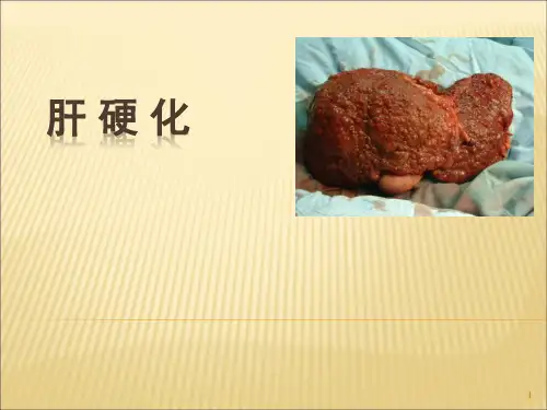 消化内科肝硬化ppt课件