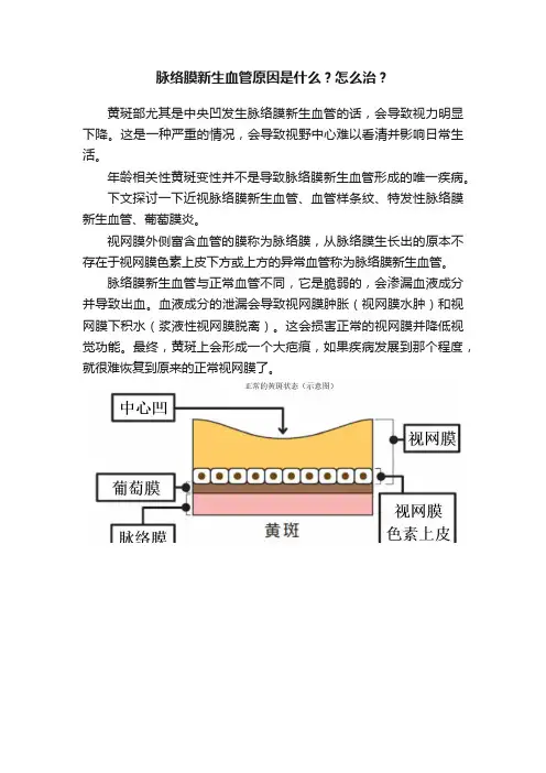 脉络膜新生血管原因是什么？怎么治？