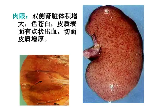 新月体性肾小球肾炎