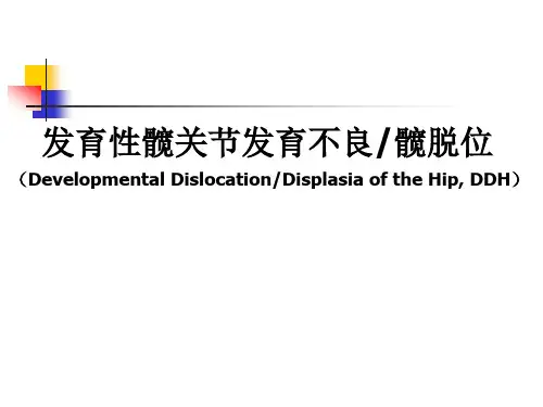 发育性髋关节发育不良髋脱位