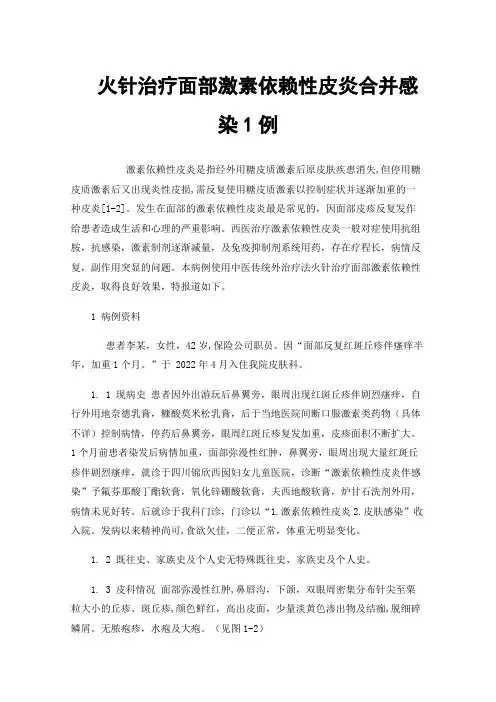 火针治疗面部激素依赖性皮炎合并感染1例
