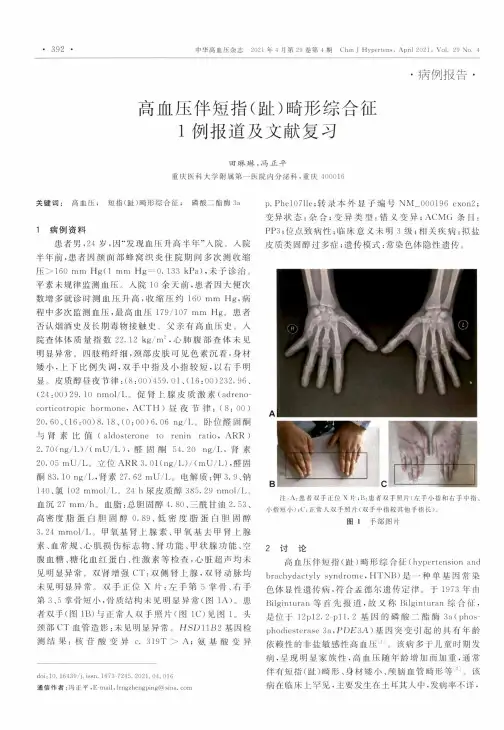高血压伴短指(趾)畸形综合征1例报道及文献复习