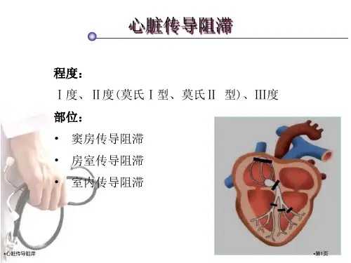 心脏传导阻滞