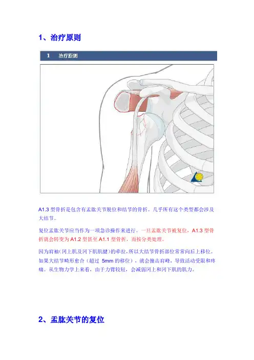 手术-肱骨近端骨折A1.3型骨折的治疗