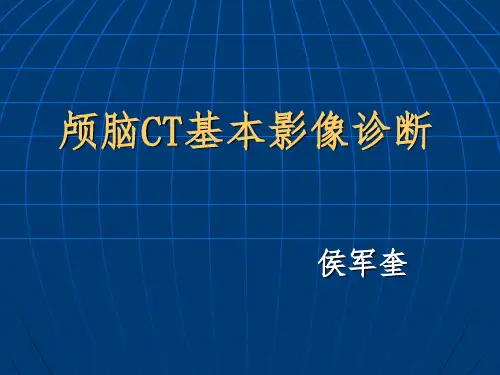 颅脑CT基本影像诊断
