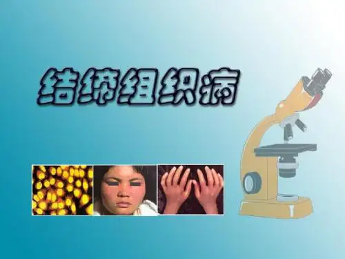 结缔组织病