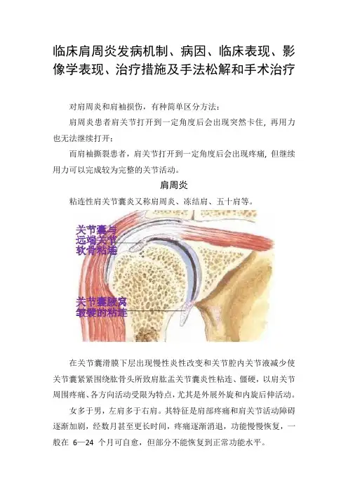 临床肩周炎发病机制、病因、临床表现、影像学表现、治疗措施及手法松解和手术治疗
