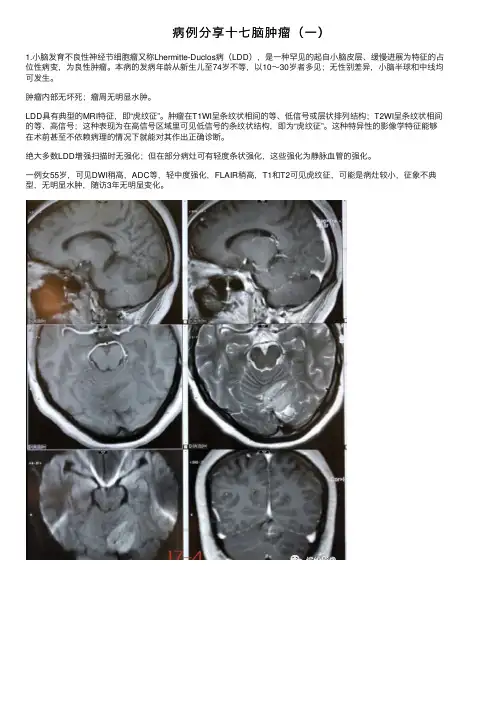 病例分享十七脑肿瘤（一）