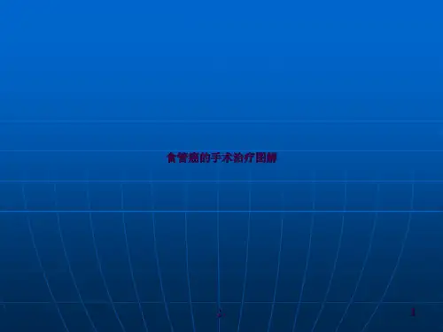 食管癌的手术治疗图解ppt课件