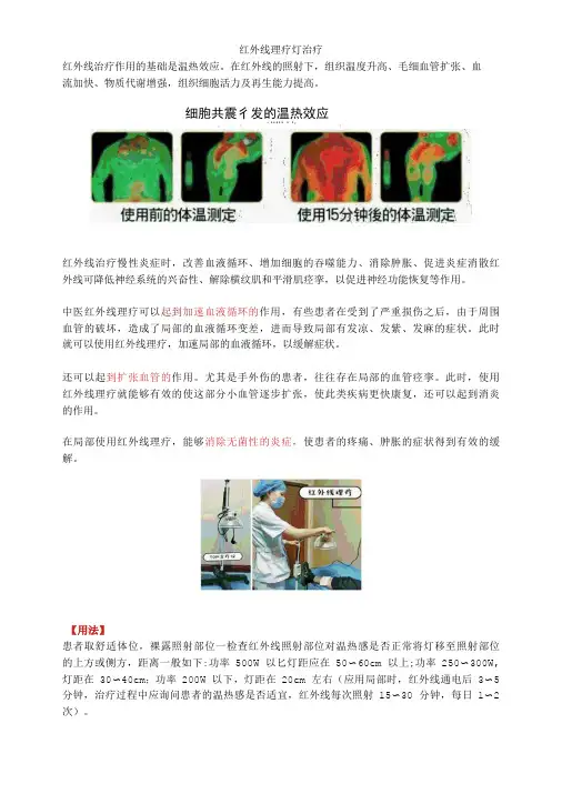 红外线理疗灯治疗